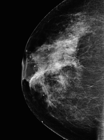 Modified Mammography from NASA Goddard Space Flight Center